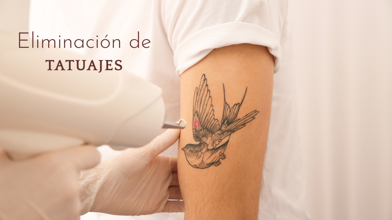 Eliminación de tatuajes con láser